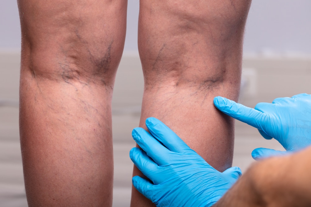 Doctor points to varicose veins on the back of patient's legs.
