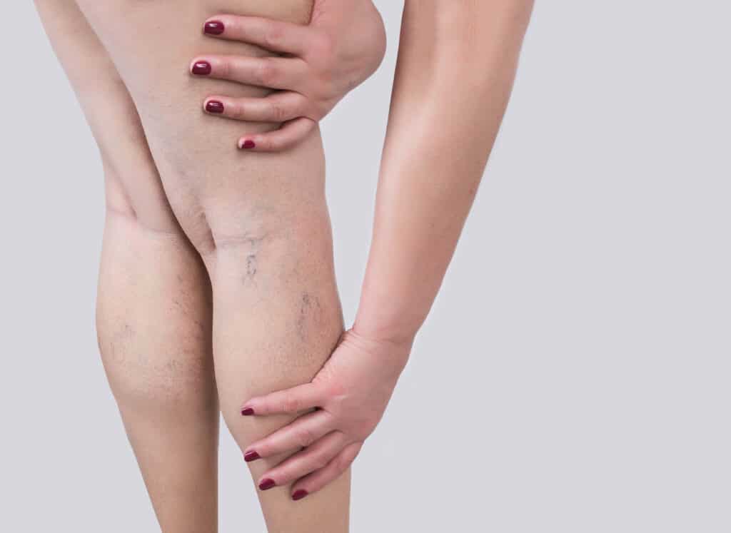 Woman grabs her legs affected by peripheral vascular disease.