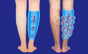 Diagram shows peripheral artery disease.