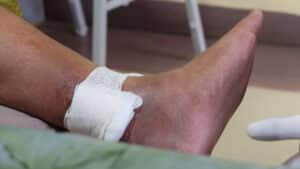Patient’s foot and ankle with a bandaged wound during vascular wound care evaluation.