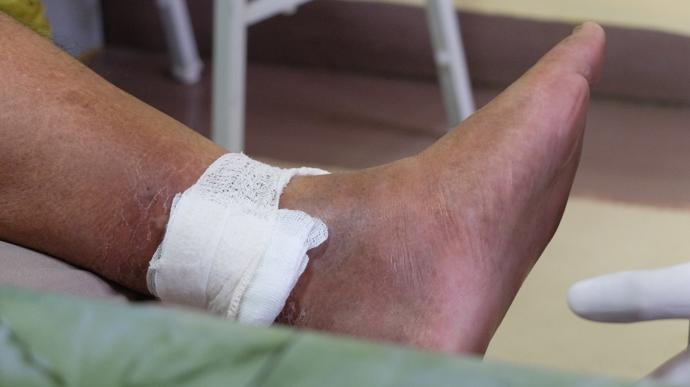 Patient’s foot and ankle with a bandaged wound during vascular wound care evaluation.