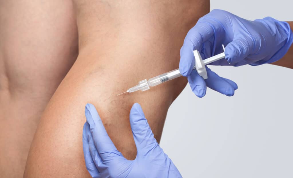 A,Doctor,Does,Medical,Procedure,Sclerotherapy,Used,To,Eliminate,Varicose Office-Based Lab (OBL) vs. Hospital for Vascular Care in Oakland & Wayne, NJ